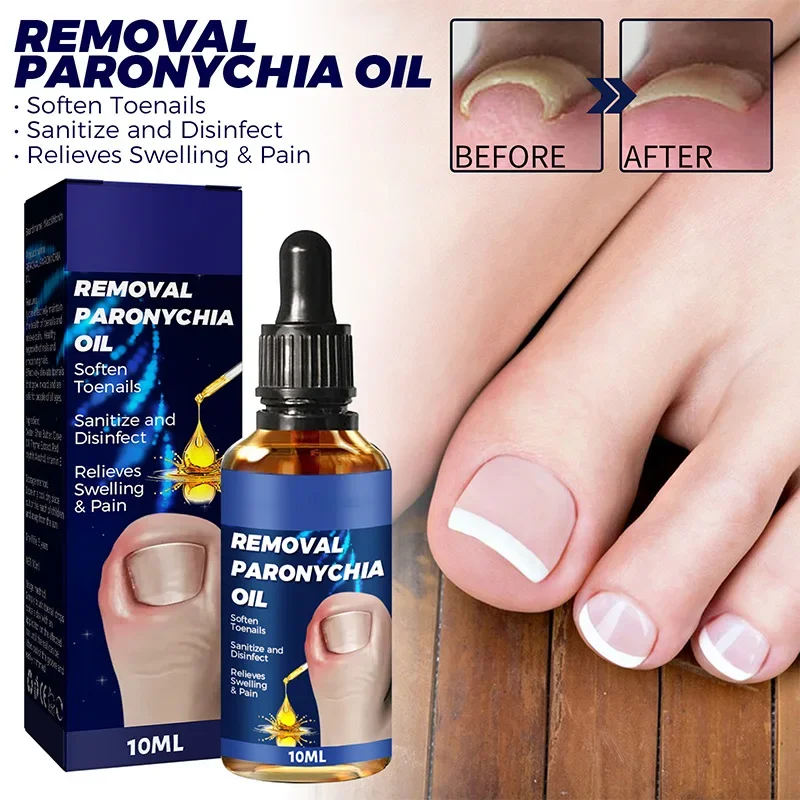 Toenailcare Removal Paronychia Oil Ingrown Toenail Treatment Nail Renewal Liquid Bad Nail Thicken Nail Soft Repair Solution