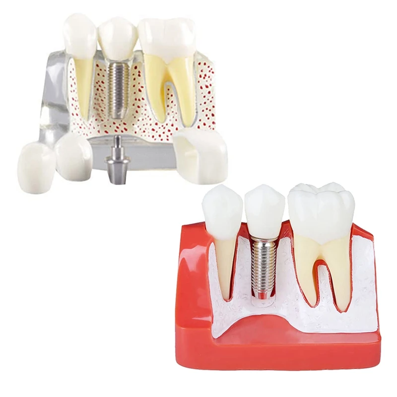 Teeth Demonstration Model Implant Removable Analysis Crown Bridge For -Patient Communication