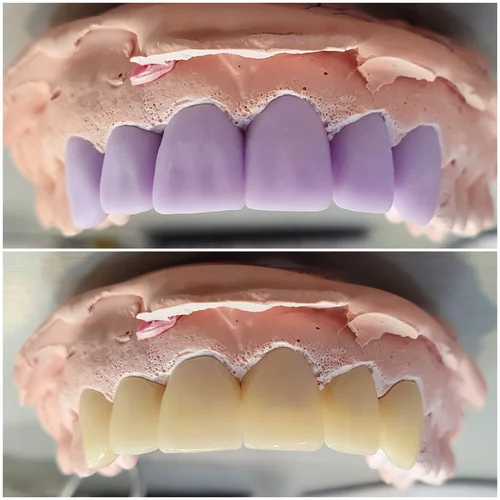 Imagen 2 del producto Bloques de disilicato de litio Ceradirect de 5 piezas E-max CAD corona de chapa de alta transparencia C14 para laboratorio Dental CAD/CAM