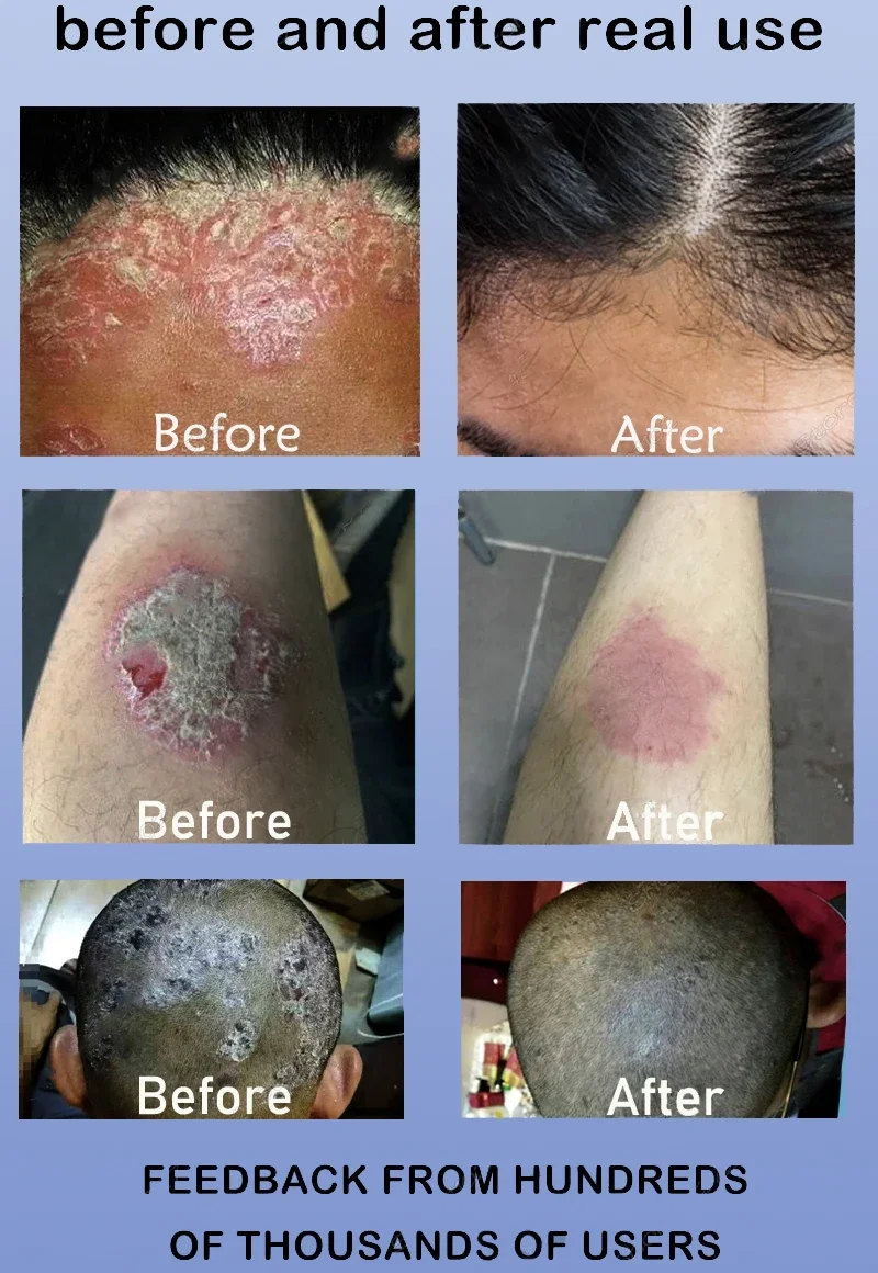 Рисунок 3 - Крем от псориаза