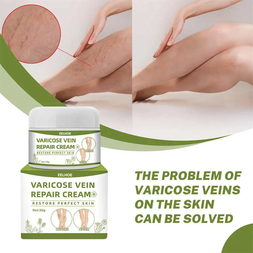 

2PC Veins Varicose Veins Cream Relief Phlebitis Angiitis Inflammation Blood Vein