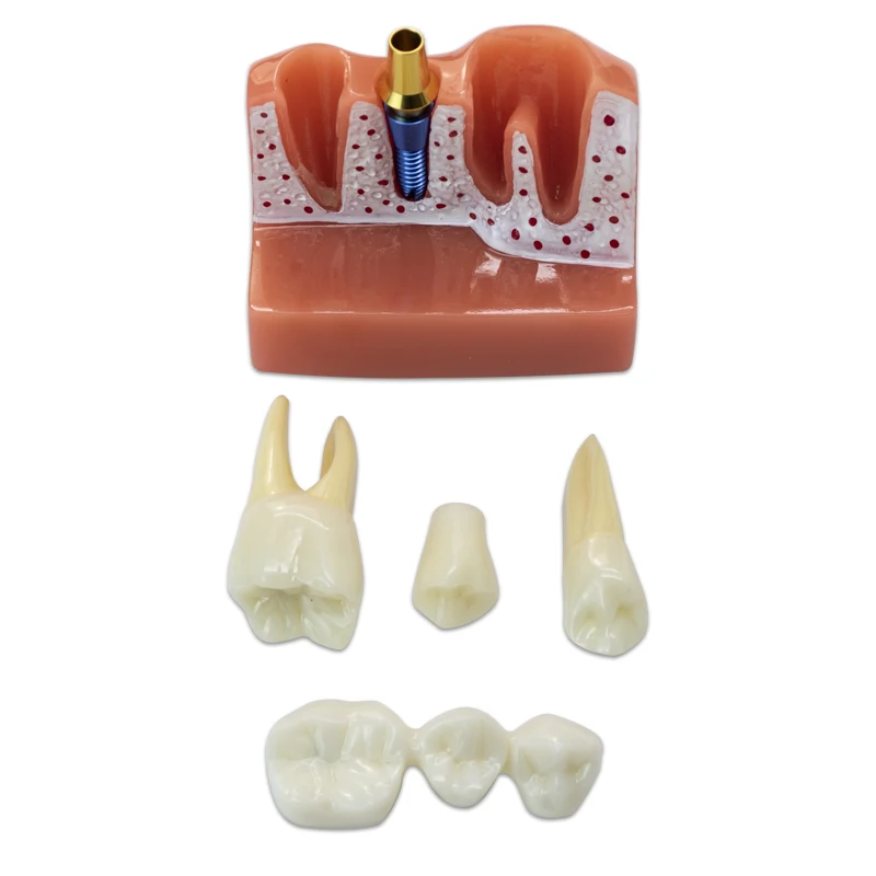 Dental Implant Model 6/8x Magnified Caries Contrast Tooth Model Crown Dental Implant Models for Doctor-patient Communication