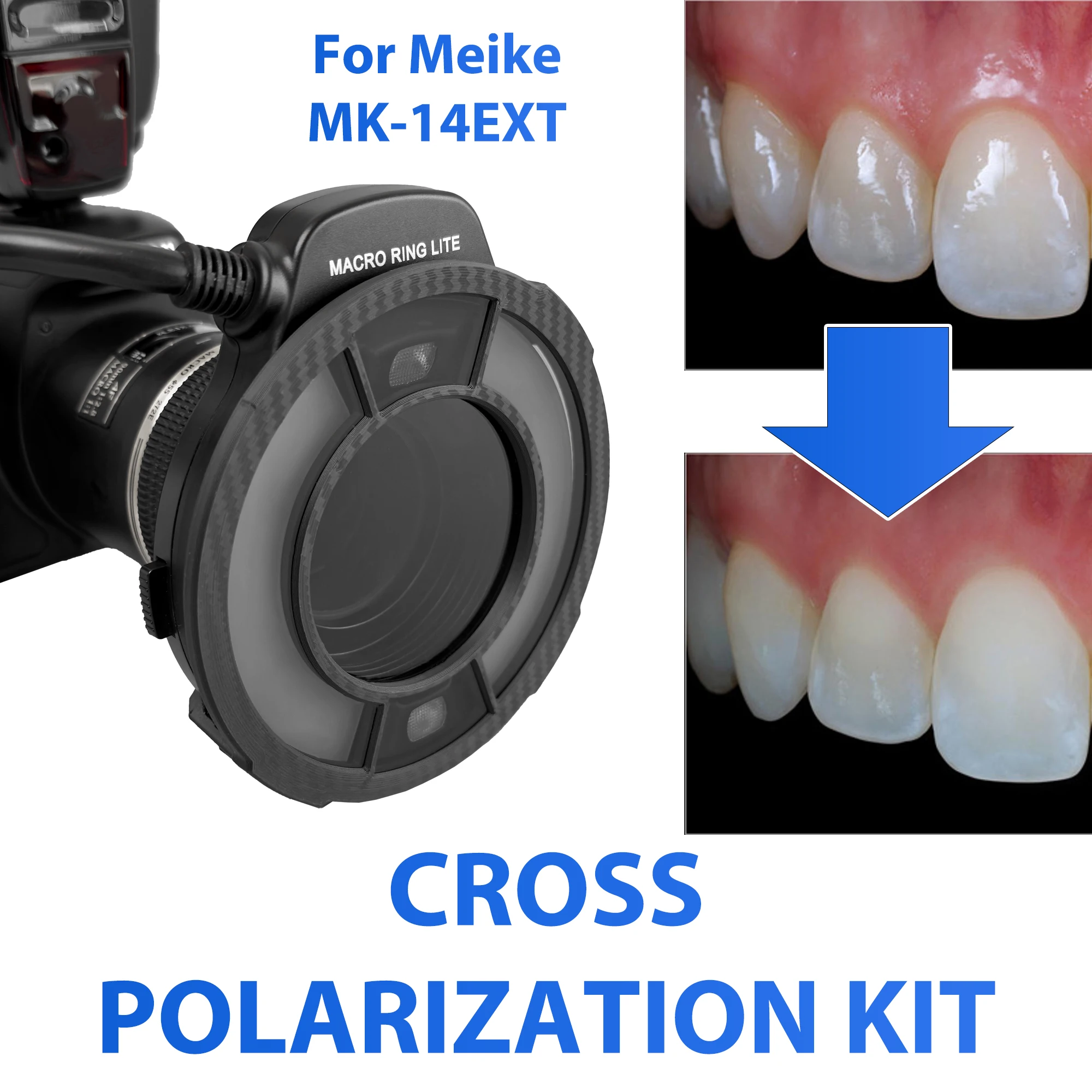 

Dental Photography Without Reflections And Glare - Dental Cross Polarization Photo For Dentist - Polar Eye For MEIKE MK-14 Flash