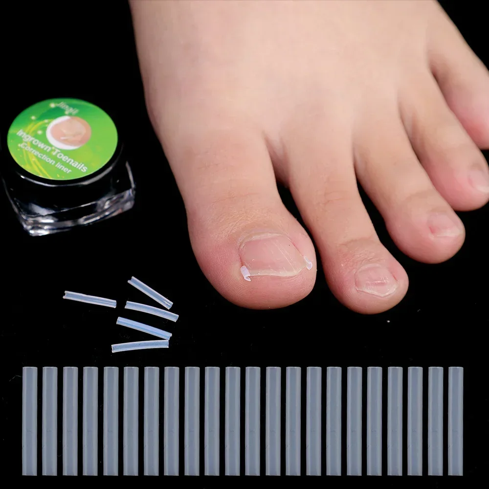 100Pc Ingrown Toenail Correction Tool Ingrown Toe Nail Treatment Elastic Patch Sticker Straightening Clip Brace Pedicure Tools