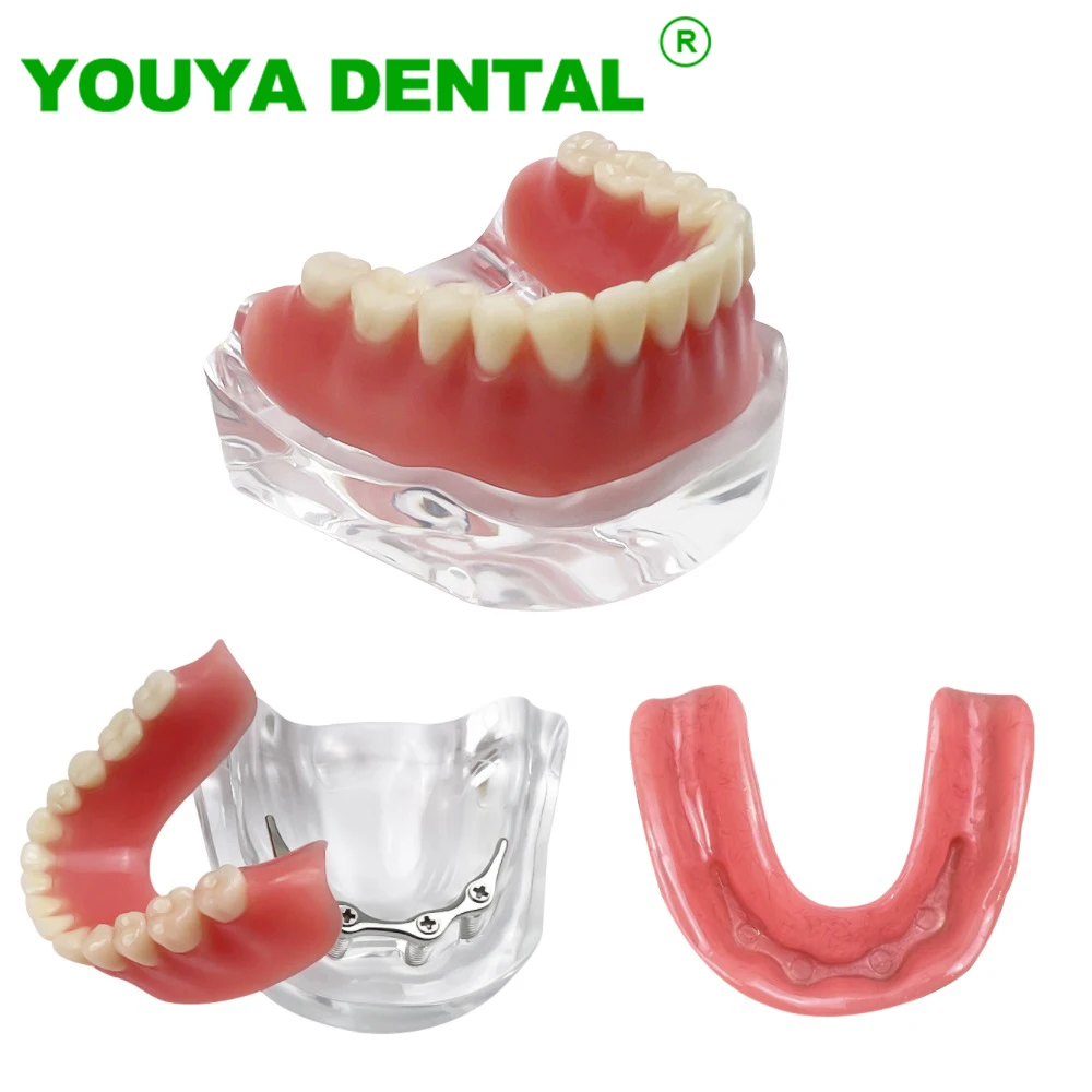 

Dental Implant Teeth Model M6008 With Silver Bar Type Typodont Overdenture 4 Implants Lower Jaw Restoration Treatment Demo Model