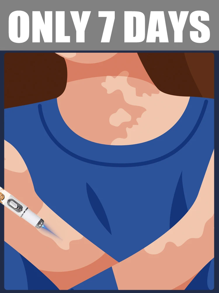 

in 7 Days Laser Generation-2 Save Vitiligo for Men Women All People Body care tools