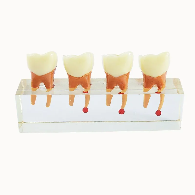 Root canal endodontic therapy model teaching dental implant restoration pathological model doctor-patient communication model