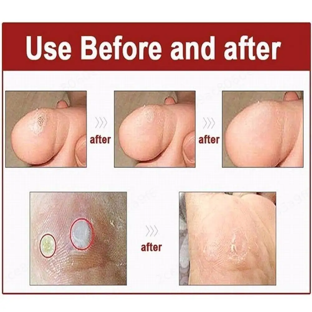 굳은살 제거 패치 발가락 보호 패드 굳은살 치료 스티커 자가 접착 부드러운 코쿤 치료 페이스트