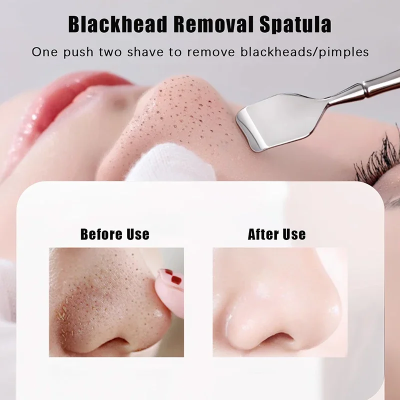 Grattoir de nettoyage de points noirs à Double tête en acier inoxydable, dissolvant de points noirs, outil d'extraction de imperfections, élimination des boutons du visage et des comédons