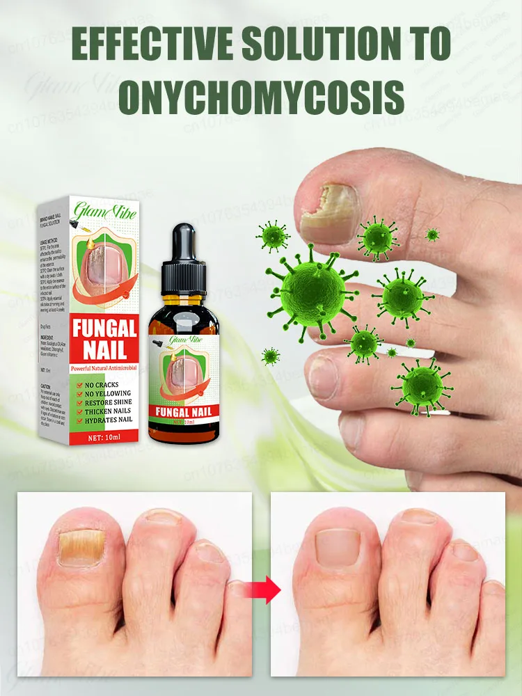 ผลิตภัณฑ์กำจัด Onychomycosis กำจัดเชื้อรานิ้วไม่เดือดร้อนจากเล็บที่น่าเกลียดอีกต่อไป