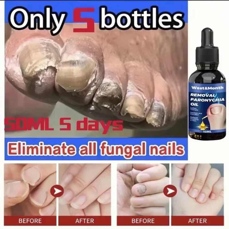 Traitement des ongles incarnés, élimination des ongles, paronyfriend, huile d'amitié, renouvellement des ongles, liquide, mauvais ongles, épaissir les ongles, solution de réparation des ongles doux