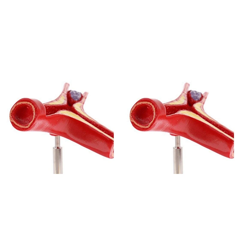 

2X Human Atherosclerosis Cardiovascular Model Vascular Anatomy Model Branch Atherosclerosis Teaching Supplies