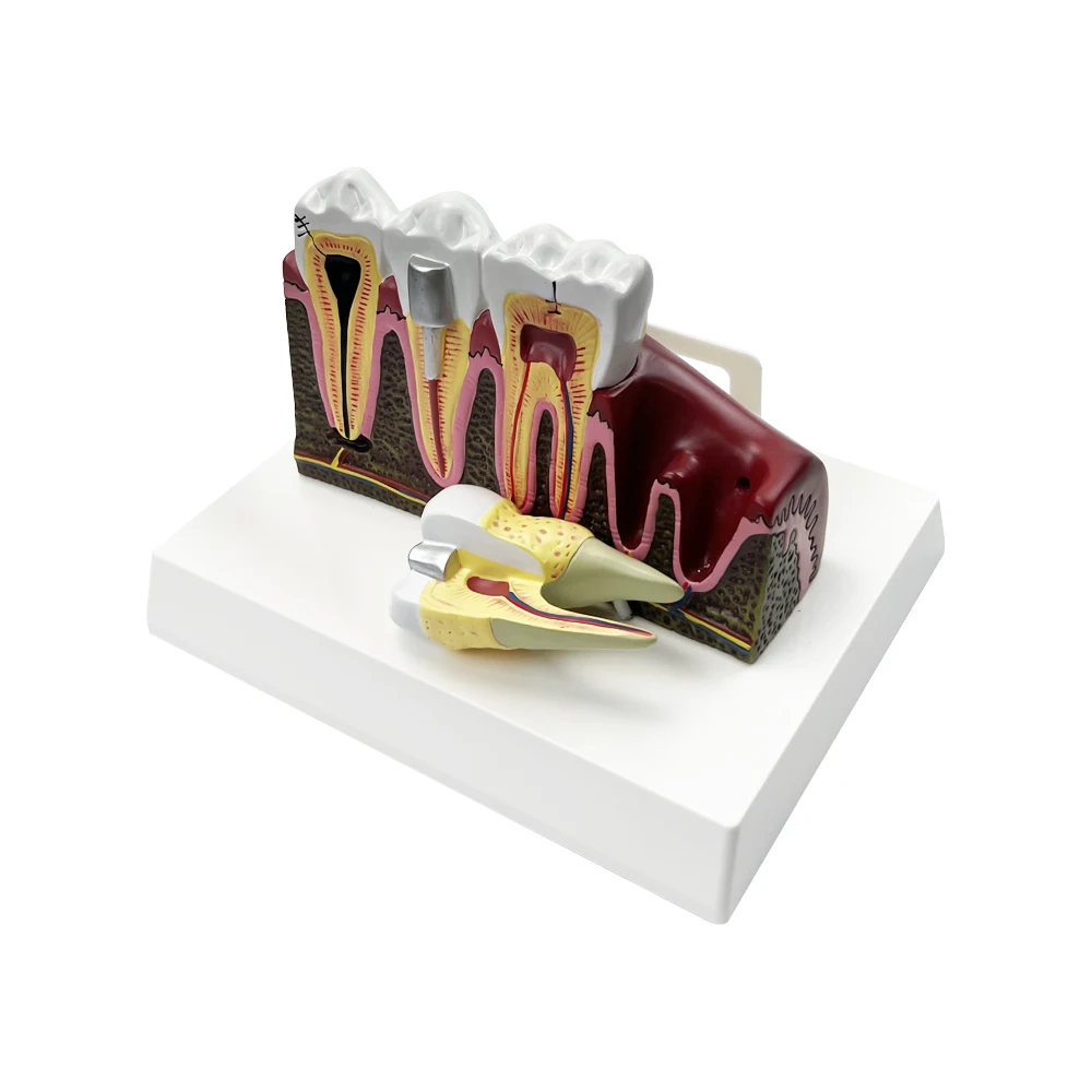 Patologie stomatologiczne anatomiczny Model struktury do nauczania badania leczenia kanałowego demonstracyjna dentysta dla pacjenta