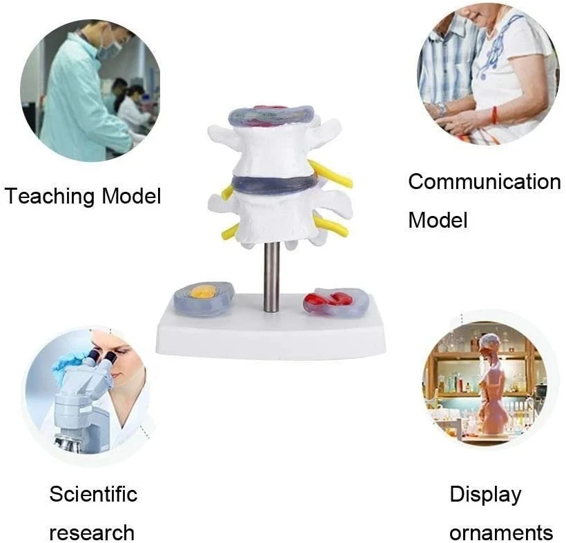 Intervertebral Disc Herniation Bone Pathology Model Lumbar Spine Bone Medicine Teaching Model Medicine Teaching