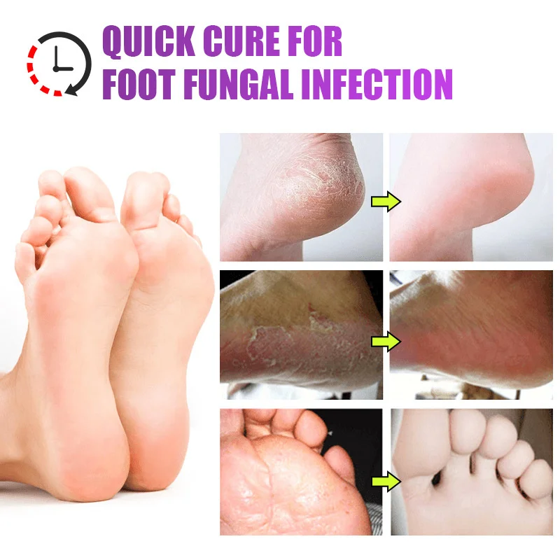 Foot Fungus Removal Cream Relieve Foot Itching Remove Beriberi Dead Skin Foot Sweat Moisturize Repair Foot Cracked Ointment