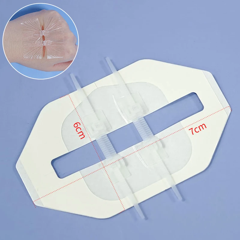 Zíper gravata fechamento de ferida remendo hemostático ferida sutura rápida zíper band-aid ao ar livre ataduras portáteis para cuidados com feridas