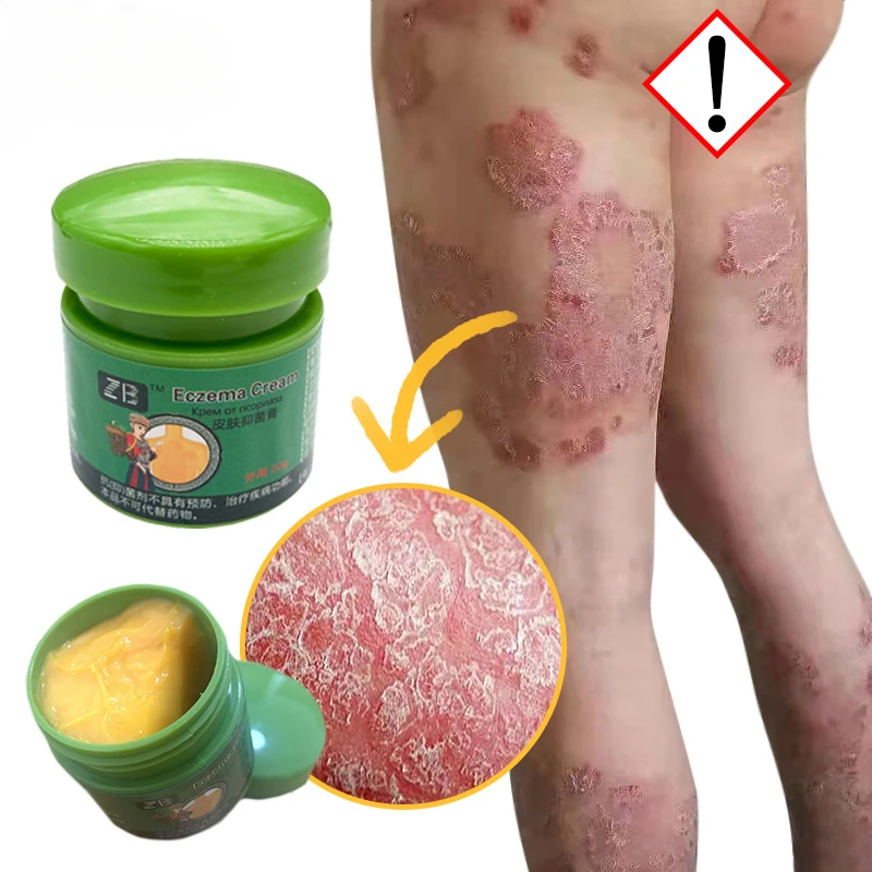 Dermatitis Eczematoid Treatment Antibacterial Ointment Herbal Psoriasis Cream Effective Body Anti-Itch Health Skin Care Product