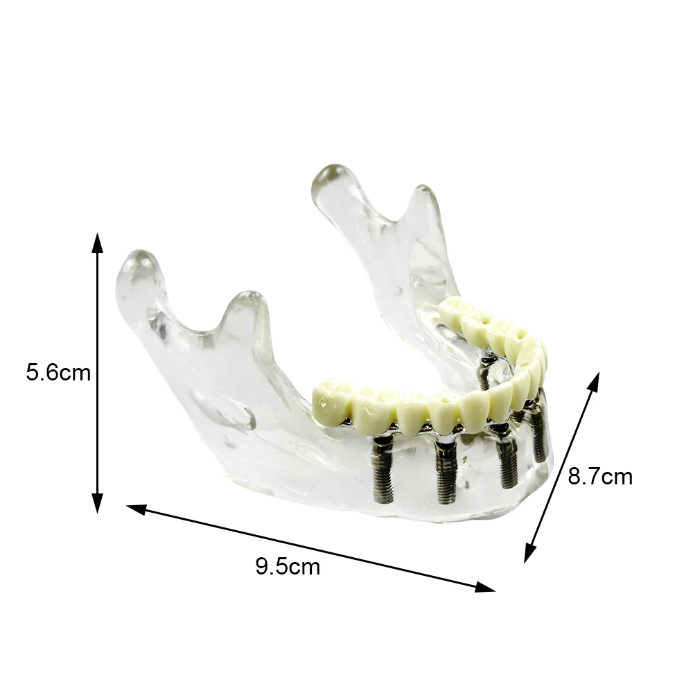 Dental 6 Implants Mandible Model Dentistry Implant Practice Model Teeth Training Model Teaching Study Dentist-Patient Education