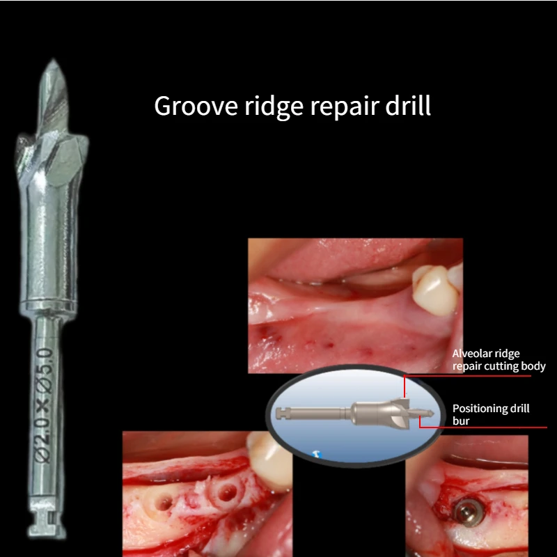 

1Pcs Dental Bone Grinding Drills for Dental Implants - Blade Shaped Alveolar Ridge Top Dressing Drills