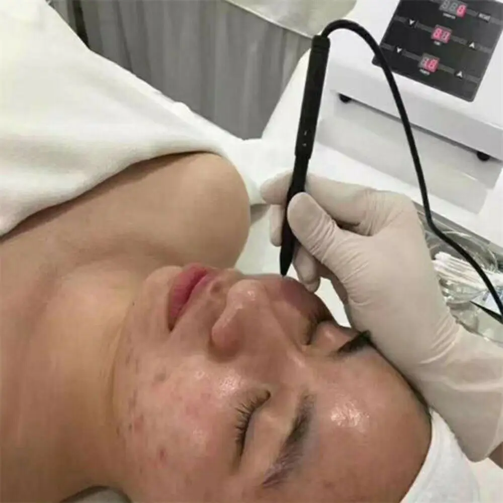 Koreański ACACIA RF mikro-izolowana igła leczenie trądziku zaskórniki maszyna do usuwania tatuaży zioma leczenie Beauty Device