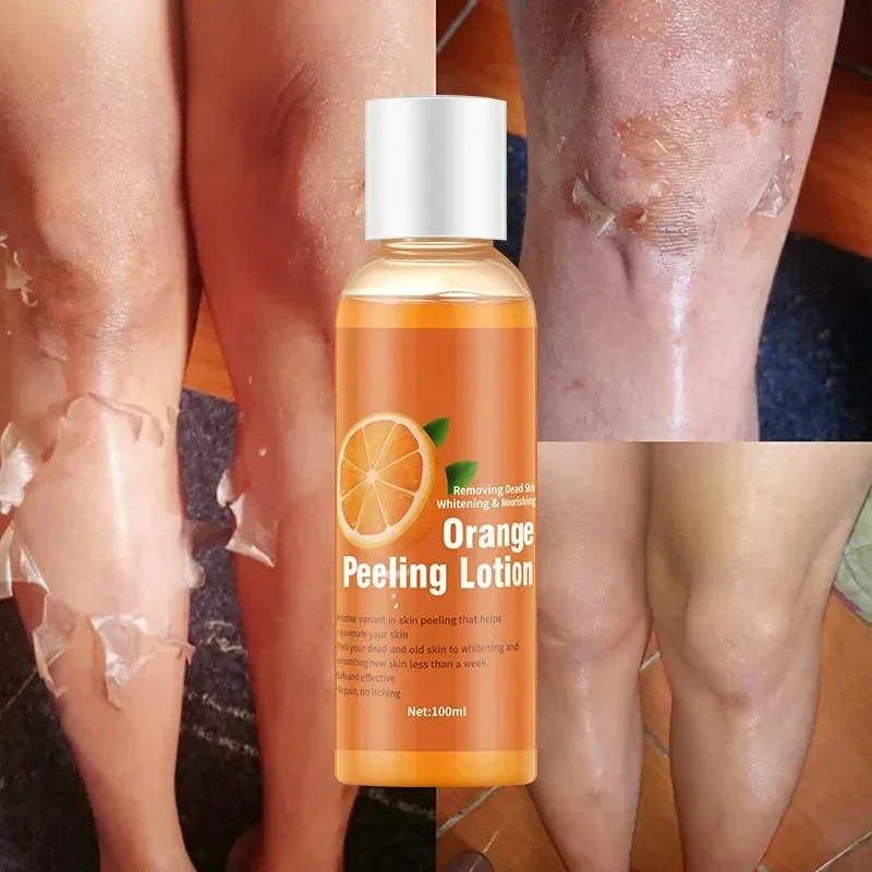 100ml Yellow Peeling Oil Bleaching Dark Skin Lighten Elbows Knees Hands Melanin Even Skin Tone Effective Whitening Body Serum
