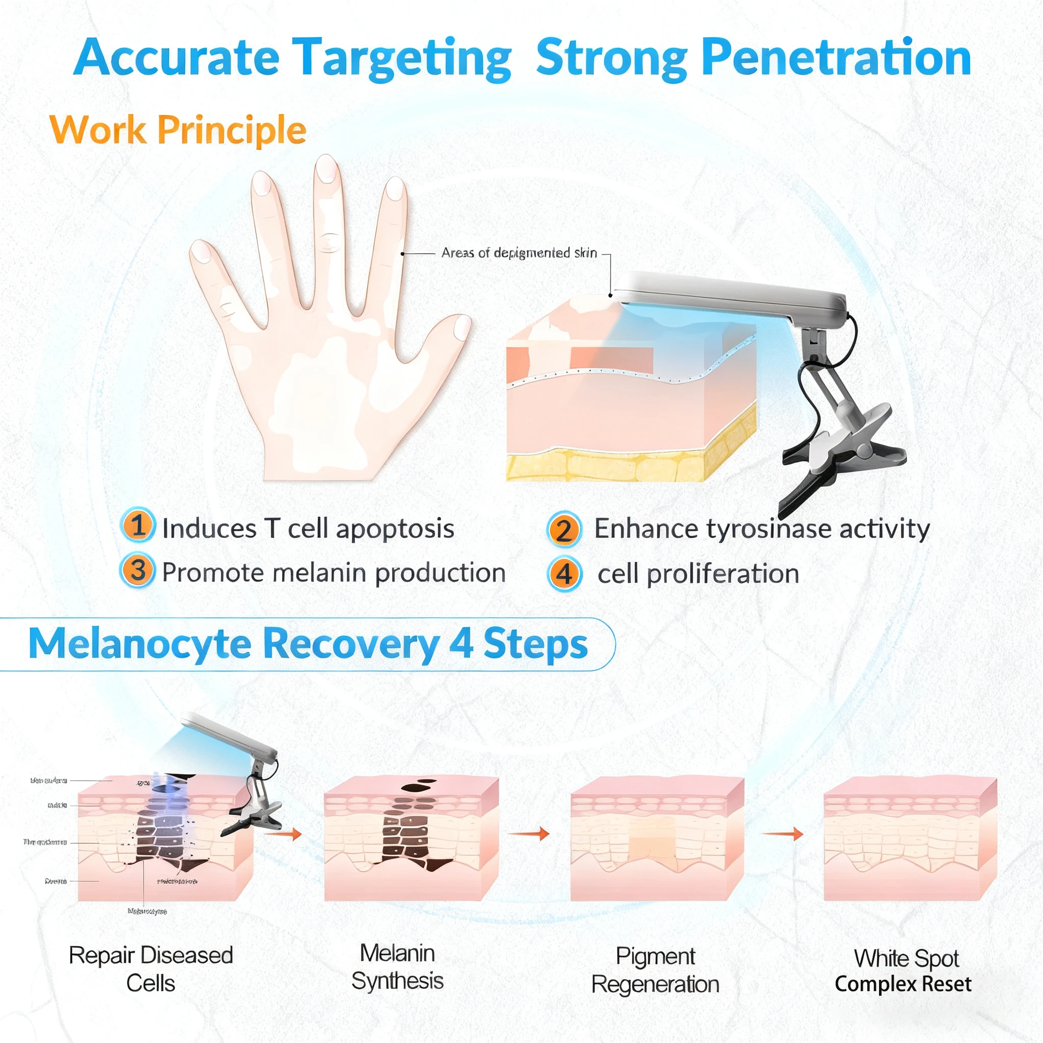 Instrumento de terapia de banda estrecha UVB de 311nm, lámpara de fototerapia UV para lámpara de terapia de Vitiligo, tratamiento de enfermedades de la piel de la Psoriasis en el hogar