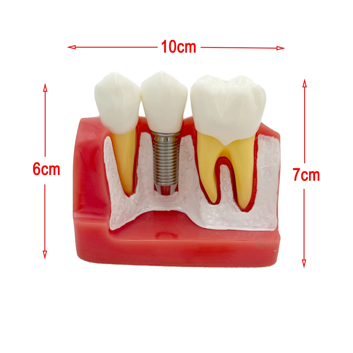 Tooth Model Dental 4 Times Implant Teeth Model Removable Analysis Crown Dentistry Demonstration Models Implants Study Training