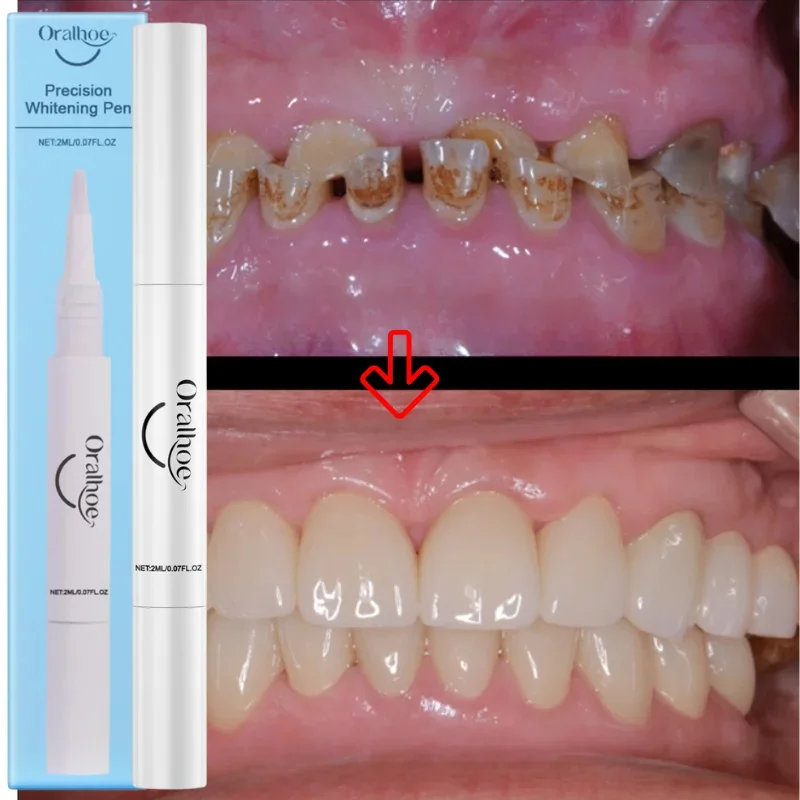 

Tooth Whitening Pen Dazzling White Teeth Whitening Pen Instant Teeth Whitening Pen Brighten Your Smile Tooth Hygiene Care Tools