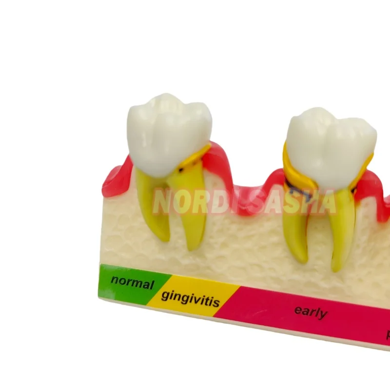 

1Pcs Dental M4010 Periodontal Disease Model 5-Stage Periodontitis Evolutionary Process Teaching Teeth Models
