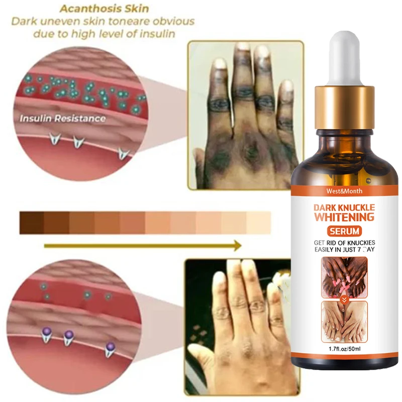 Donkere Knokkels Snel Whitening Serum Intense Vlekken Verwijderaar Hand Knokkel Ellebogen Knie Melanine Corrector Producten Schoonheidsverzorging 50Ml