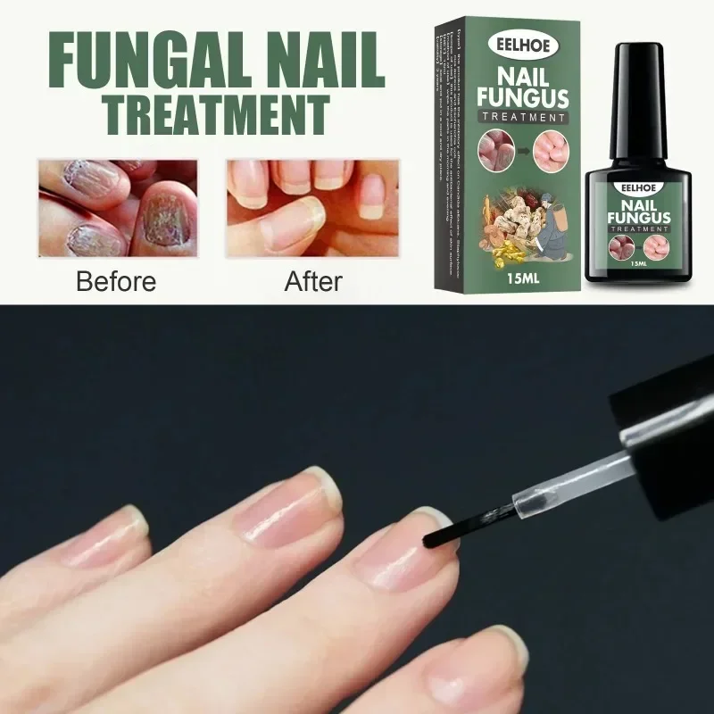 Nail Fungal Treatment Essence Oil Foot Toe Nail Fungus Removal Serum 7 Days Repair Onychomycosi Anti Infection Gel Care Products