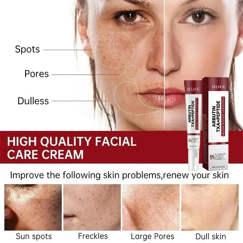 Crema sbiancante lentiggine Melasma macchie scure prodotti per la rimozione della pigmentazione dissolvenza macchia melanina riparazione illuminare