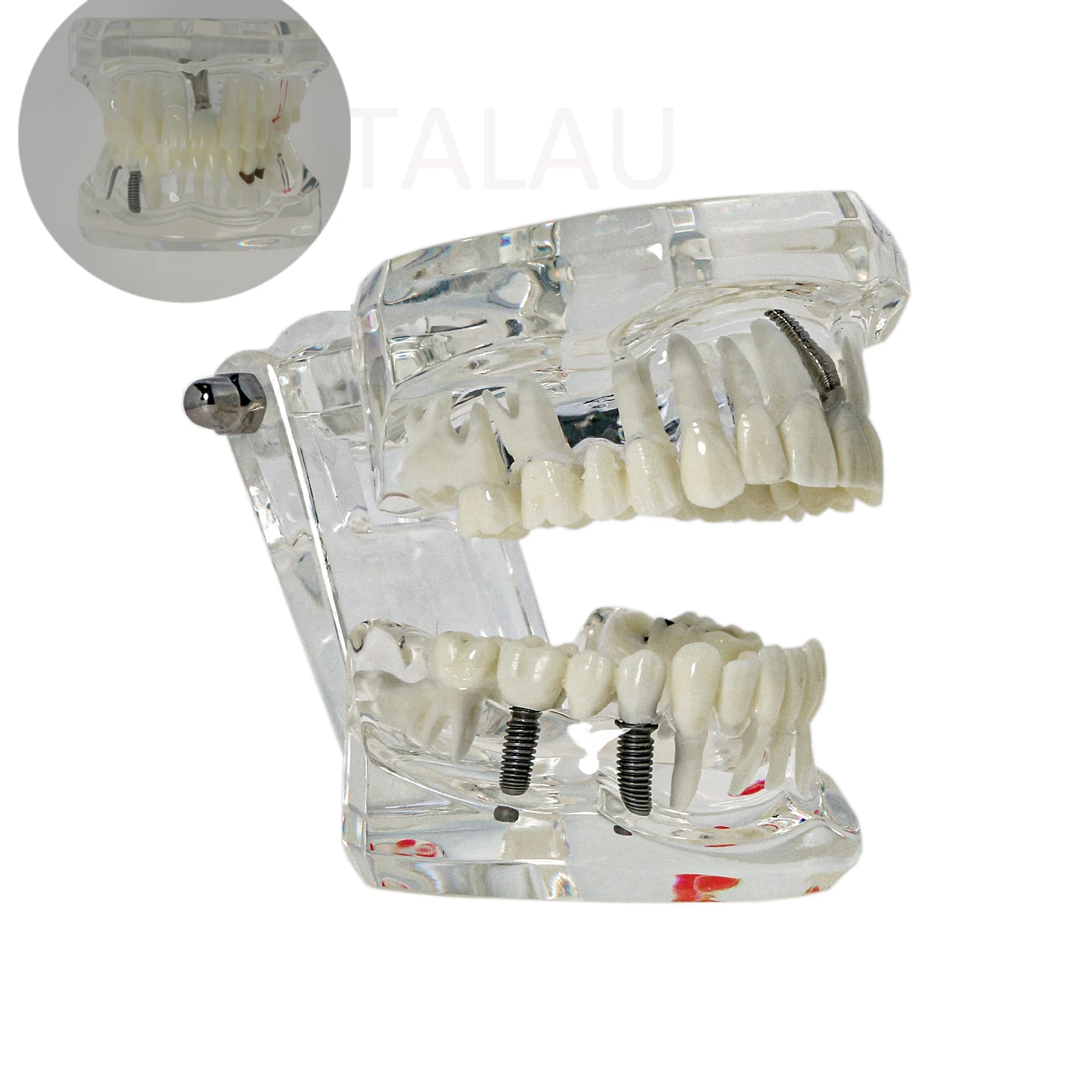 

Dental lmplant Typodonts Teeth Model Restoration Pathology Teach Study M2001C