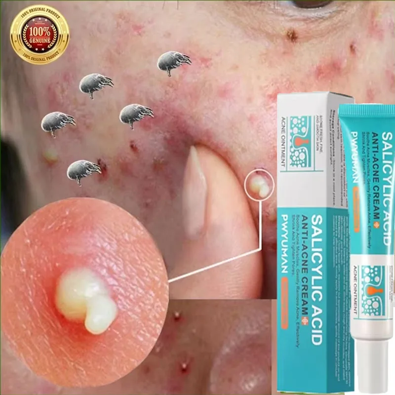 

Salicylic Acid Acne Treatment Cream Shrink Pore Remove Blackheads Scars Acne Marks Spots Oil Control Whitening Korean Skin Care