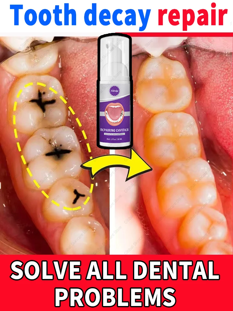 

Tooth Decay repair