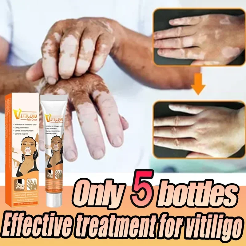 Vitiligo ครีมลบกลาก White Spot Removal ผิว Vitiligo กําจัด Vitiligo ครีม Body Skin Care