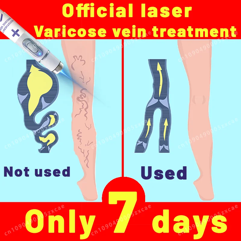 

Used for varicose veins, perfect solution for leg problems.