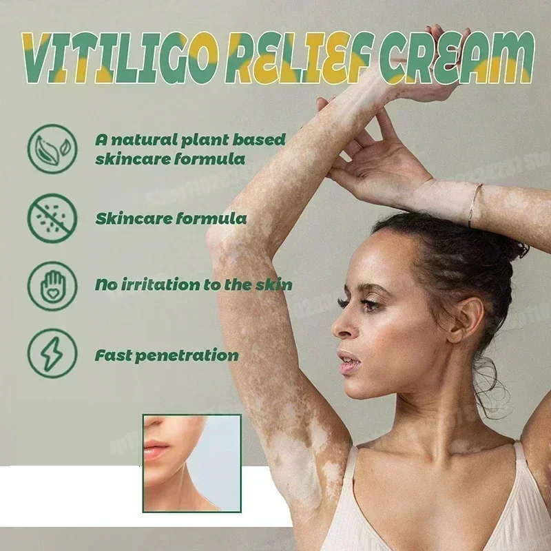 Vitiligo-Creme, entfernt Ringelflechte, entfernt weiße Flecken und entfernt die Haut Vitiligo, beseitigt Vitiligo-Creme