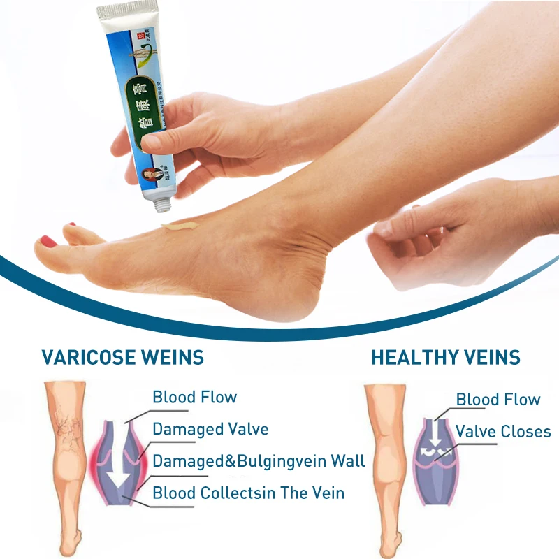 10PCS Chinese Natural Herbal Medicine For Treating Varicose Vascular Inflammation Massage Cream Cure Varicose Vein Ointment