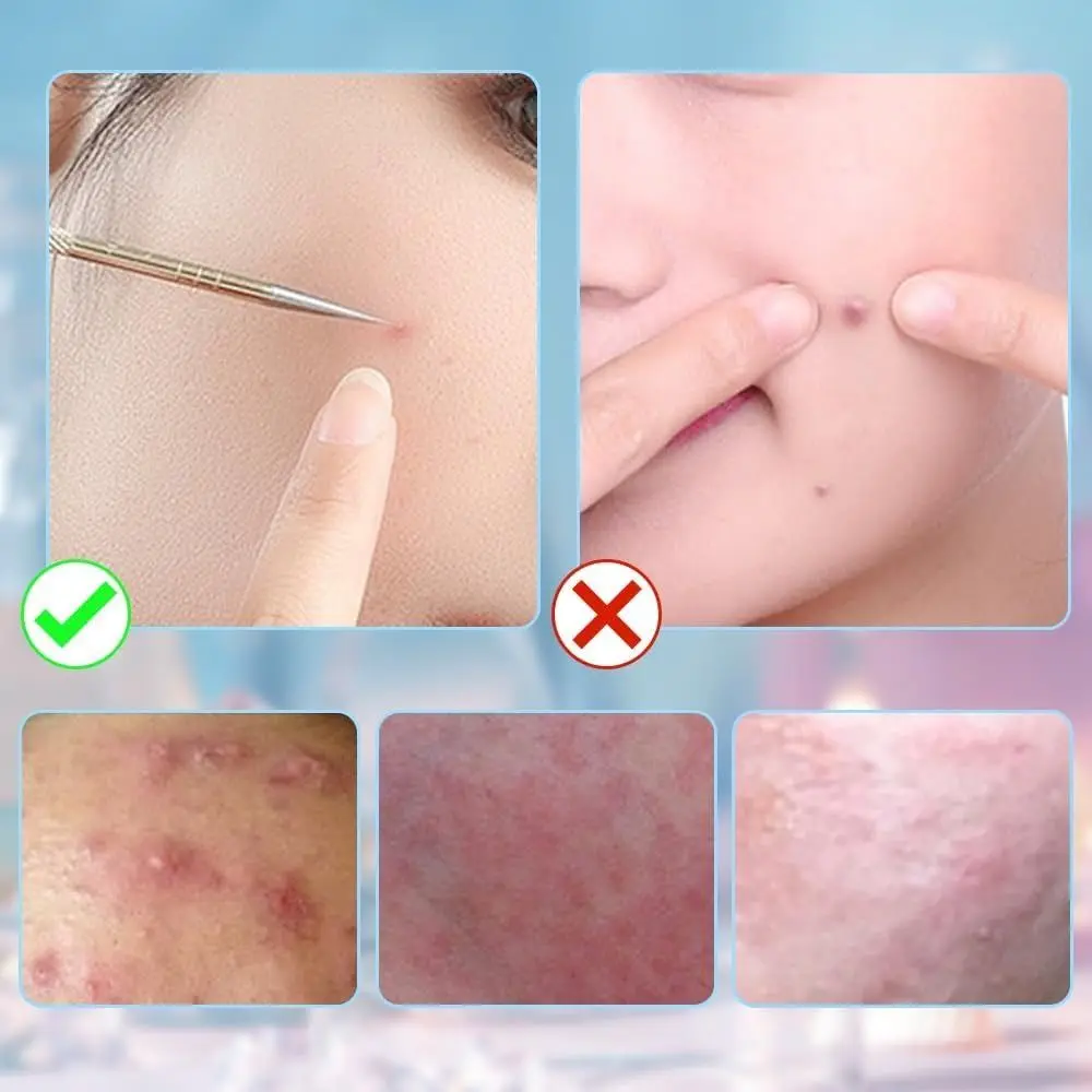 Zestaw narzędzi do usuwania zaskórników ze stali nierdzewnej, usuwanie zaskórników z twarzy, trwałe pęsety do usuwania zaskórników.