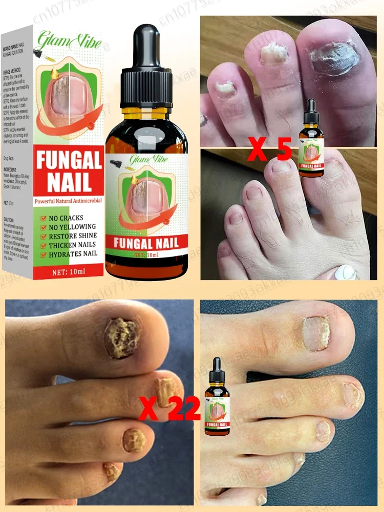 Foot nail problems disappear