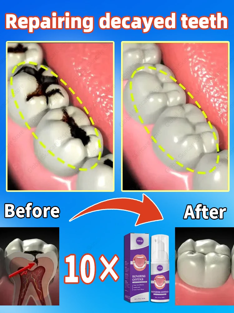 decay Tooth Repair Repairing Cavities Protect Anti caries