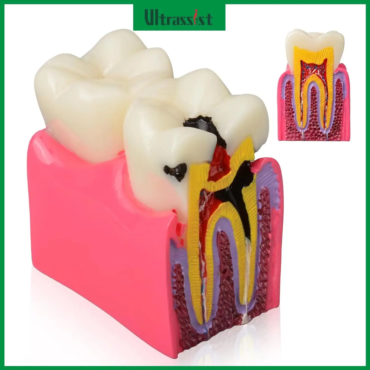 

Ultrassist Dental Tooth Caries Model Dental Decay Demonstration Model Tooth Anatomy Teaching for Oral Health Classroom Education