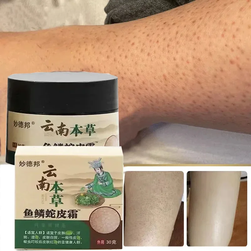 Chicken Skin Repair Cream Curing Keratosis Follicle Pilaris Body Dark Spot Remove Thick Pores Moisturizing Smooth Essence