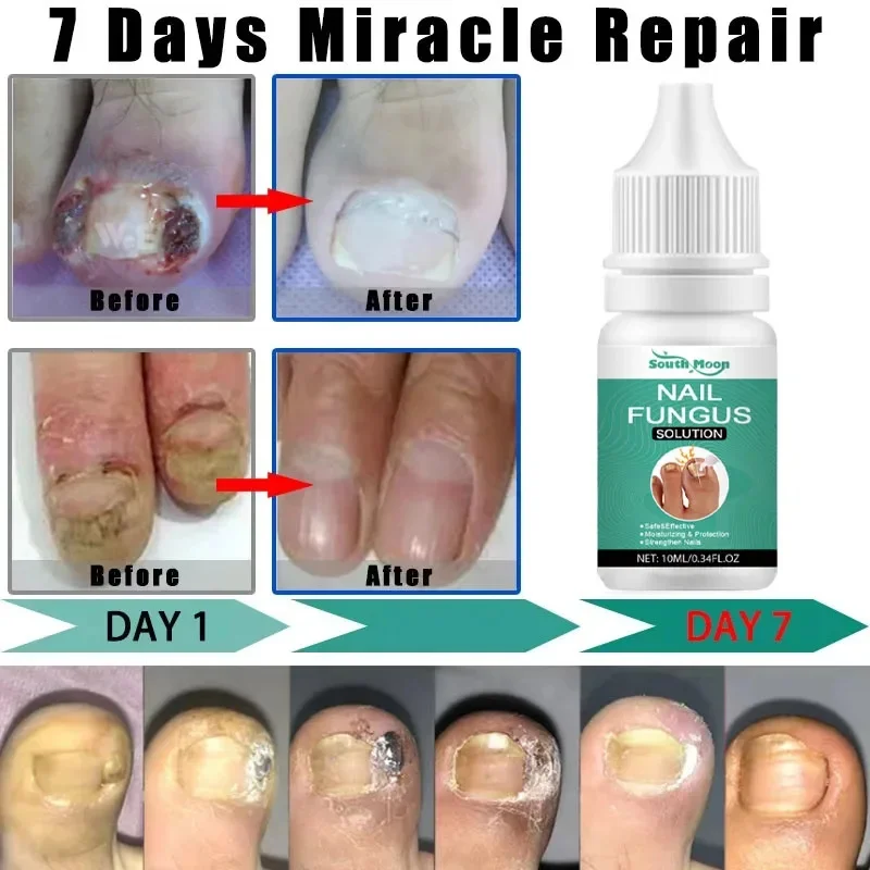 Fungal Nail Treatment Essence Oil Nail Fungus Laser Device Repair Toenail Fingernail Ginger Treatment Hand Foot Essence Liquid