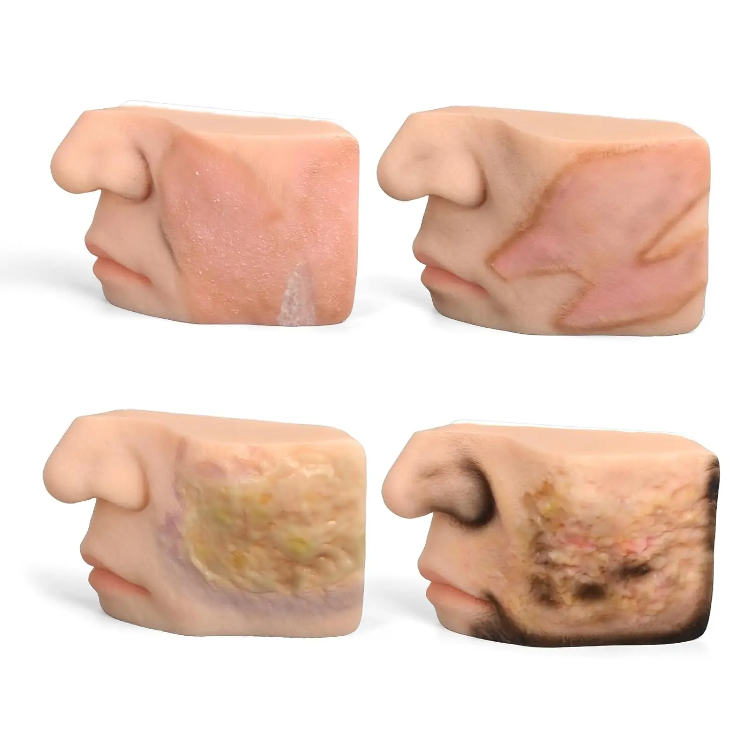 Chemical Burn Wound Facial Model First to Fourth Degree Silicone Wound Simulation Tissue Damage for Medical Nursing Education