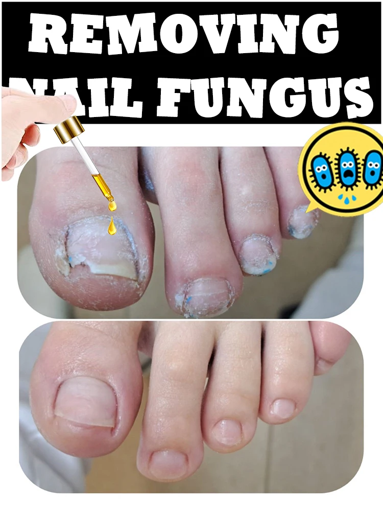 High-efficiency nail microbial oil equipment, for discolored and thickened toenails, strengthening repair