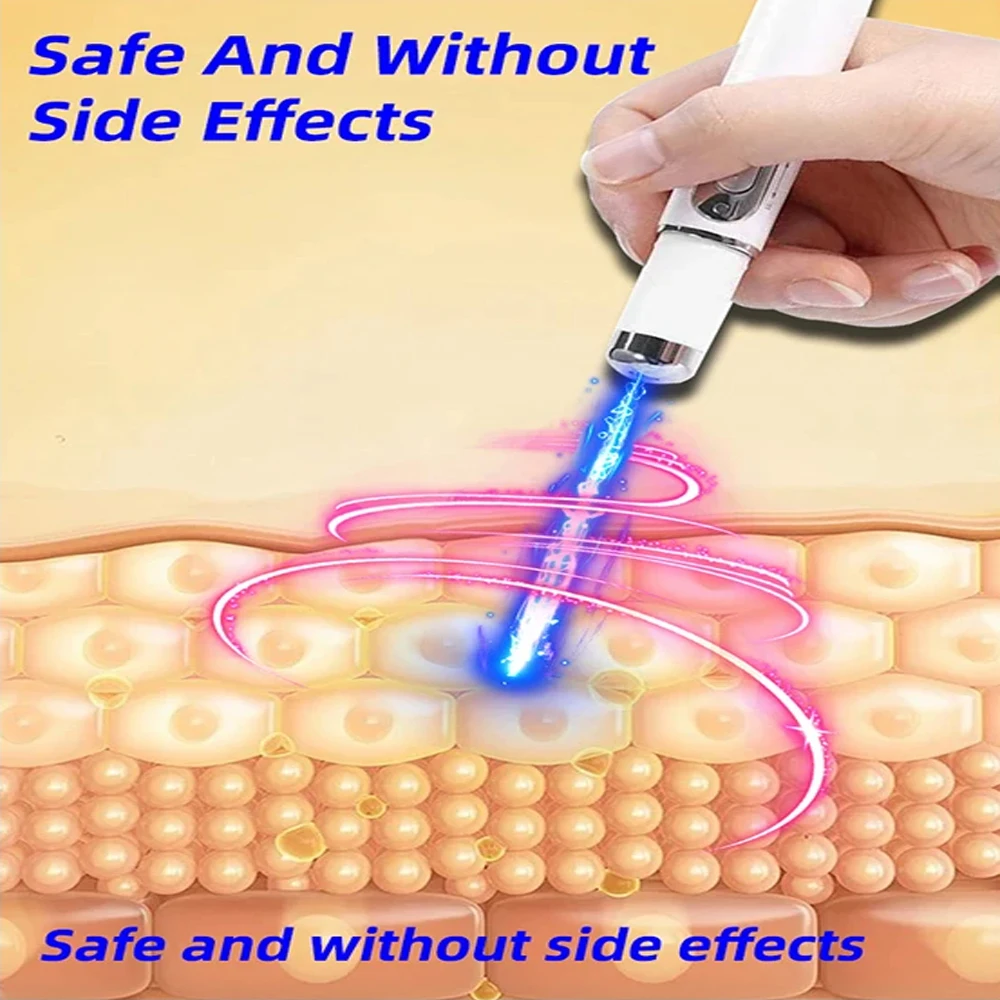 Scar Relief Pen Laser therapy Keloid Scar Easy Harmless Comfortable Improve Keloid Scar Pen Scar Relief Products