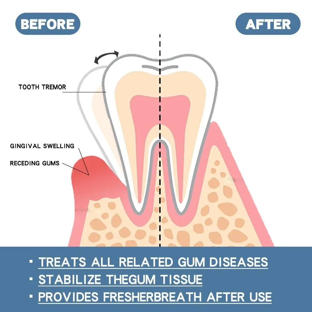 Effectively 30ml Gum Repair Serum Dental Caries Tooth Cleaning Gum Relief Drops Tooth Damage Tooth Allergy Bad Breath Remover