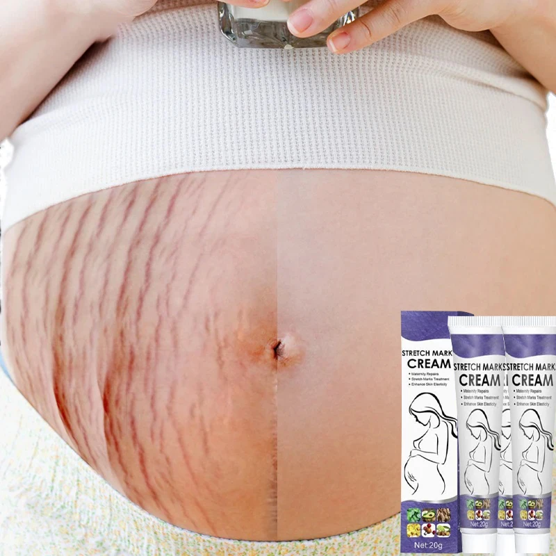 Gentle Skin Care Improves Elasticity Effective After Pregnancy Stretch Marks Removal Powerful Maternity Cream Nourishes Skin